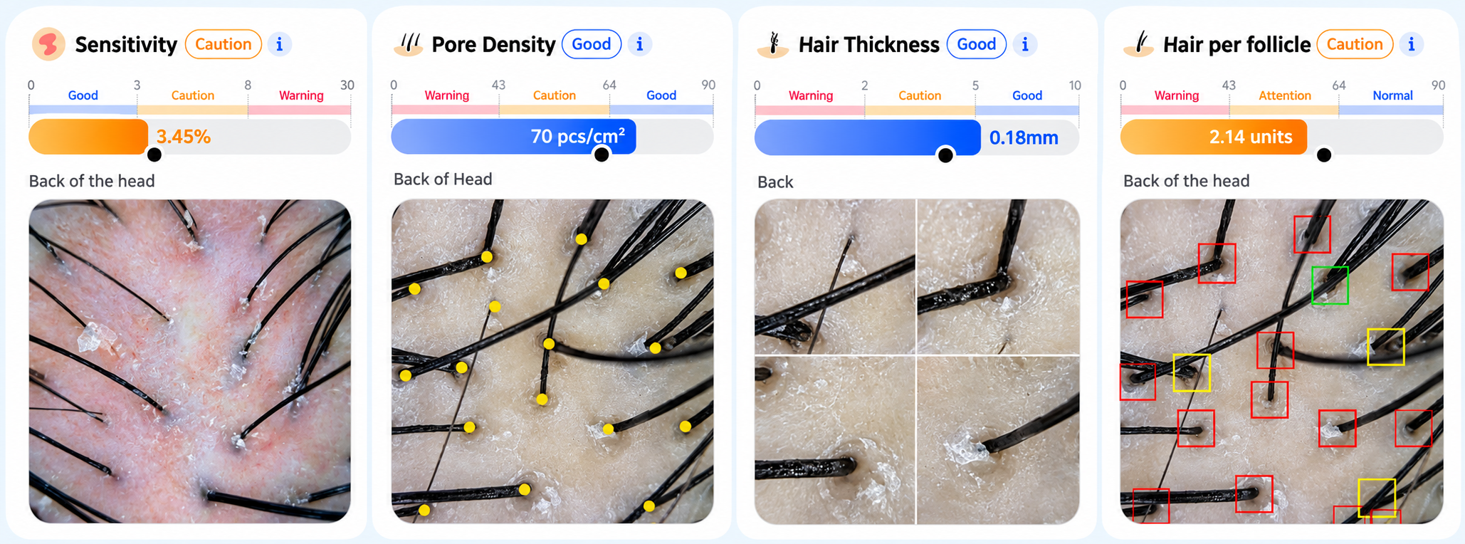 Sample scalp analysis results for sensitivity, pore density, hair thickness and hair per follicle, with magnified scalp images