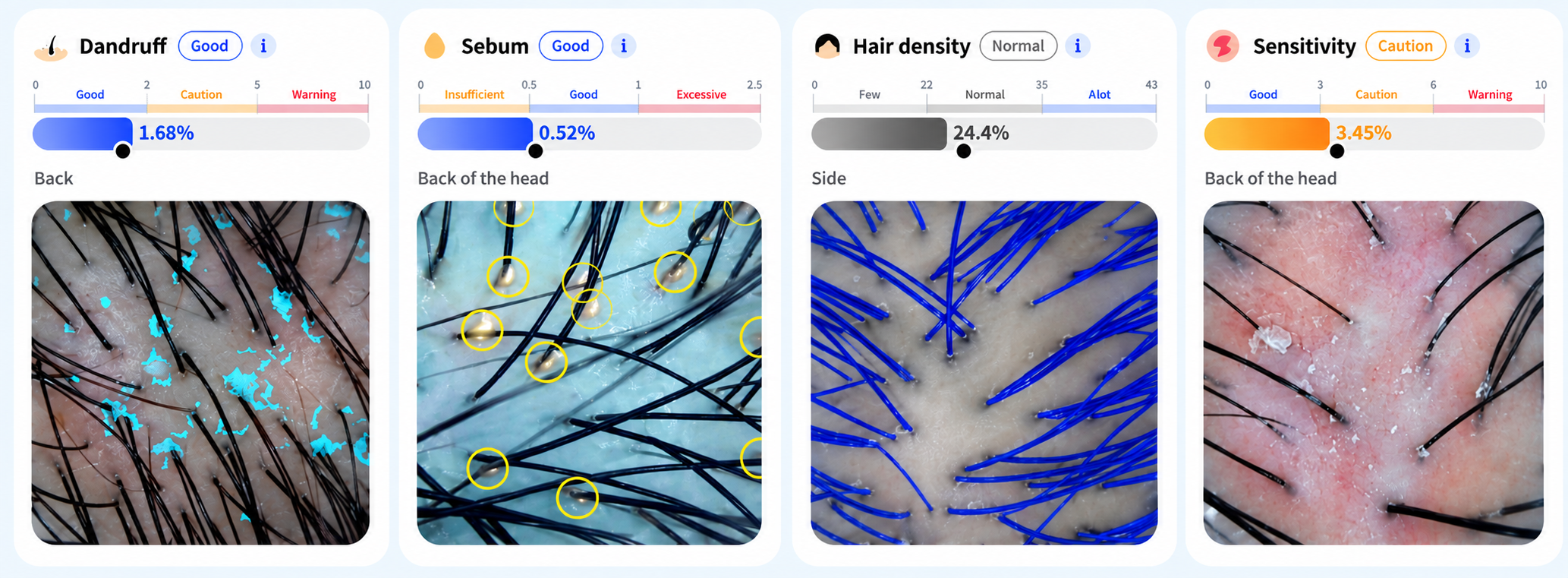 Sample scalp analysis results for dandruff, sebum, hair density and sensitivity, with magnified scalp images