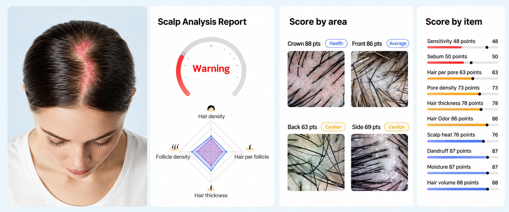 Sample AI scalp analysis report showing an overall score, hair and follicle radar breakdown, and results scored by scalp area