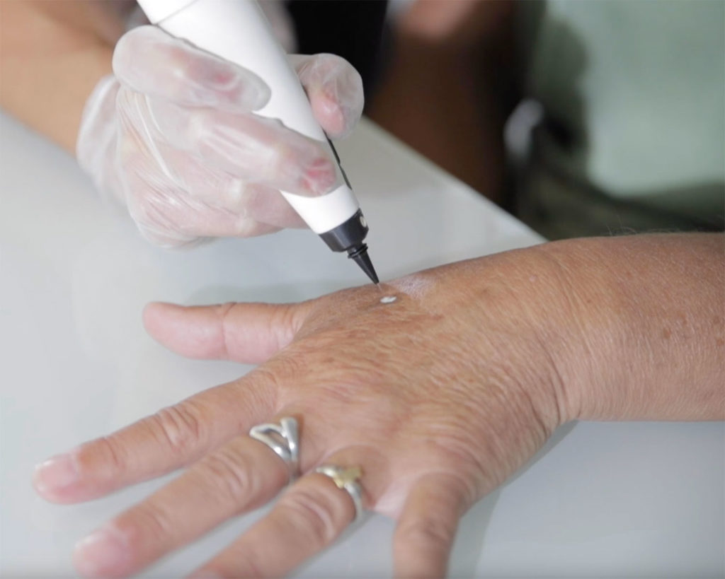 CryoPen treatment in progress — precision freezing of a lesion on a patient's hand