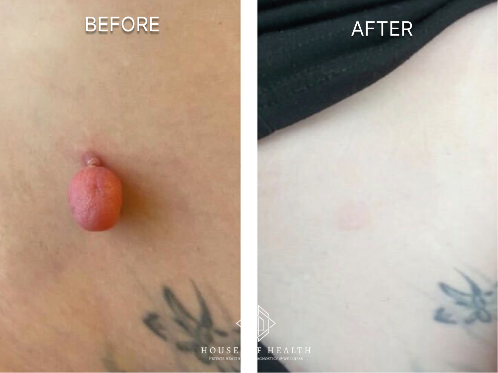 Large Skin Tag (Torso) — before and after skin lesion removal treatment