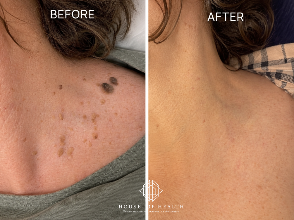 Multiple Skin Tags (Shoulder) — before and after skin lesion removal treatment