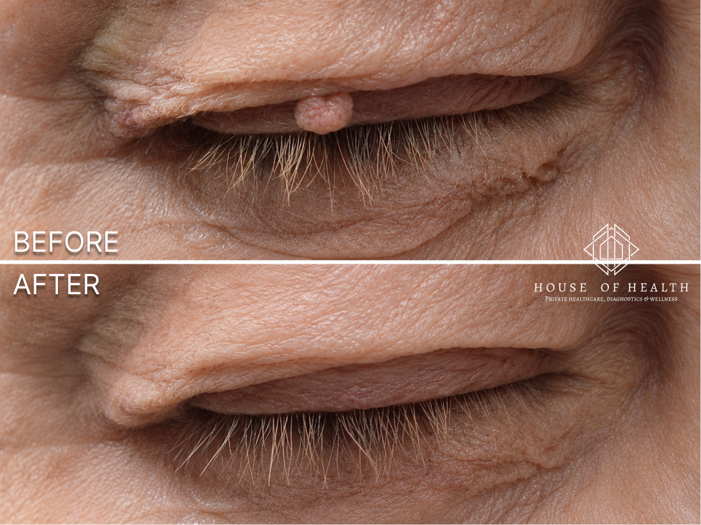 Skin Tag (Eyelid) — before and after skin lesion removal treatment
