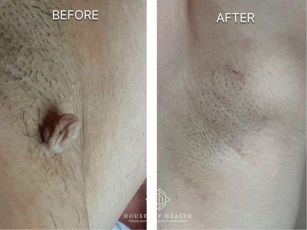 Skin Tag (Underarm) — before and after skin lesion removal treatment