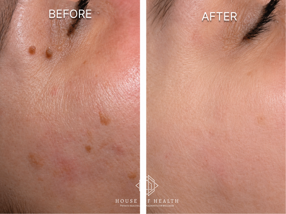 Skin Tags (Eye Area) — before and after skin lesion removal treatment