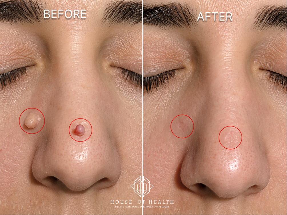 Skin Tags (Face) — before and after skin lesion removal treatment