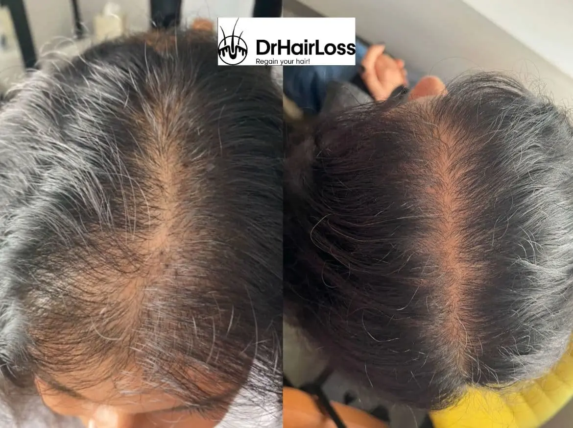 Hair loss treatment before and after comparison
